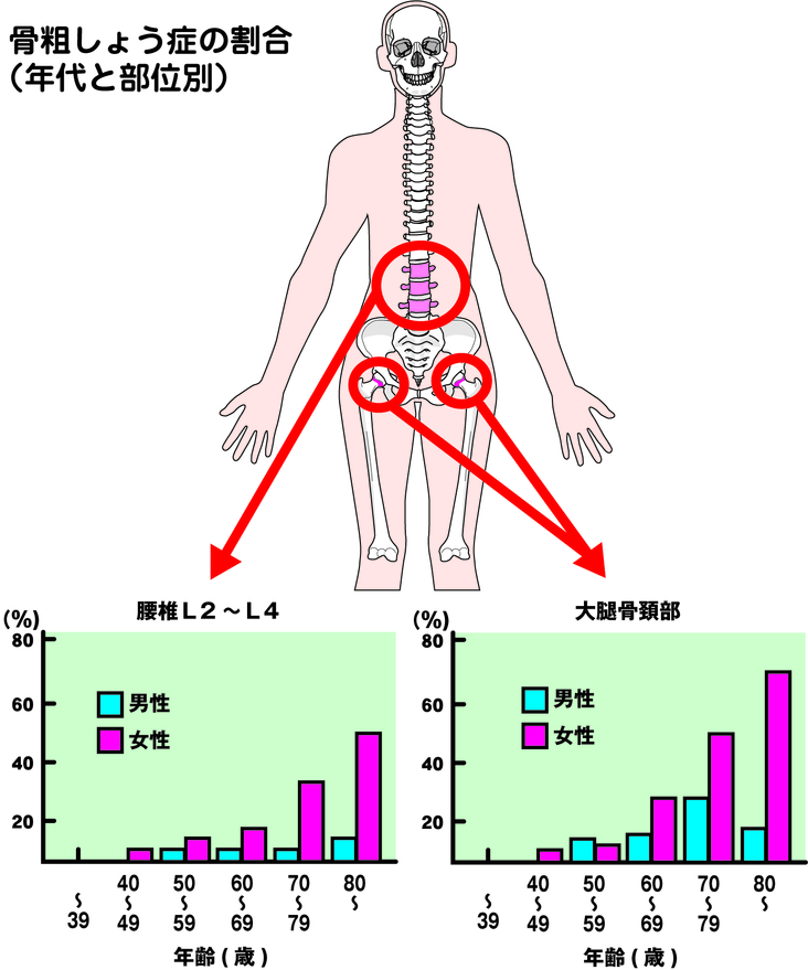 骨粗しょうの年代別の図